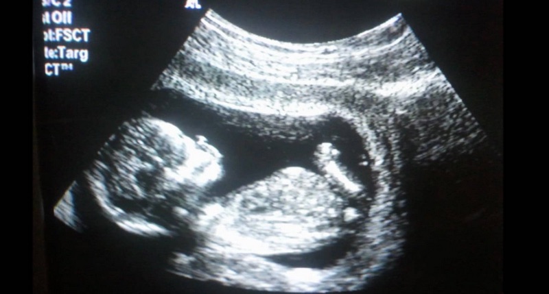 Gli ultrasuoni sono così sicuri per il nascituro?